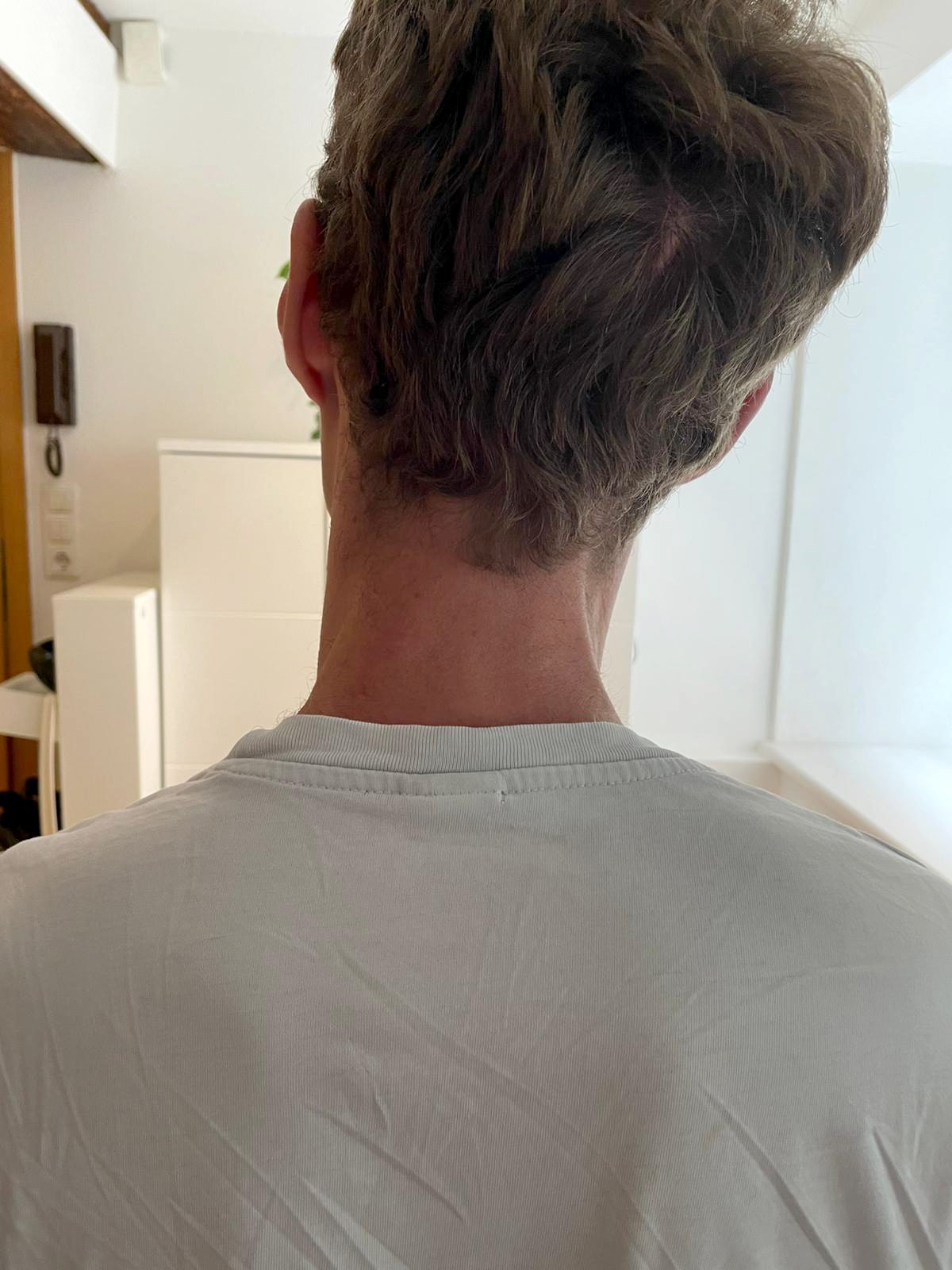 Thai Massage Behandlung Vorher - Patient mit Rückenproblemen vor Behandlungsbeginn in Konstanz