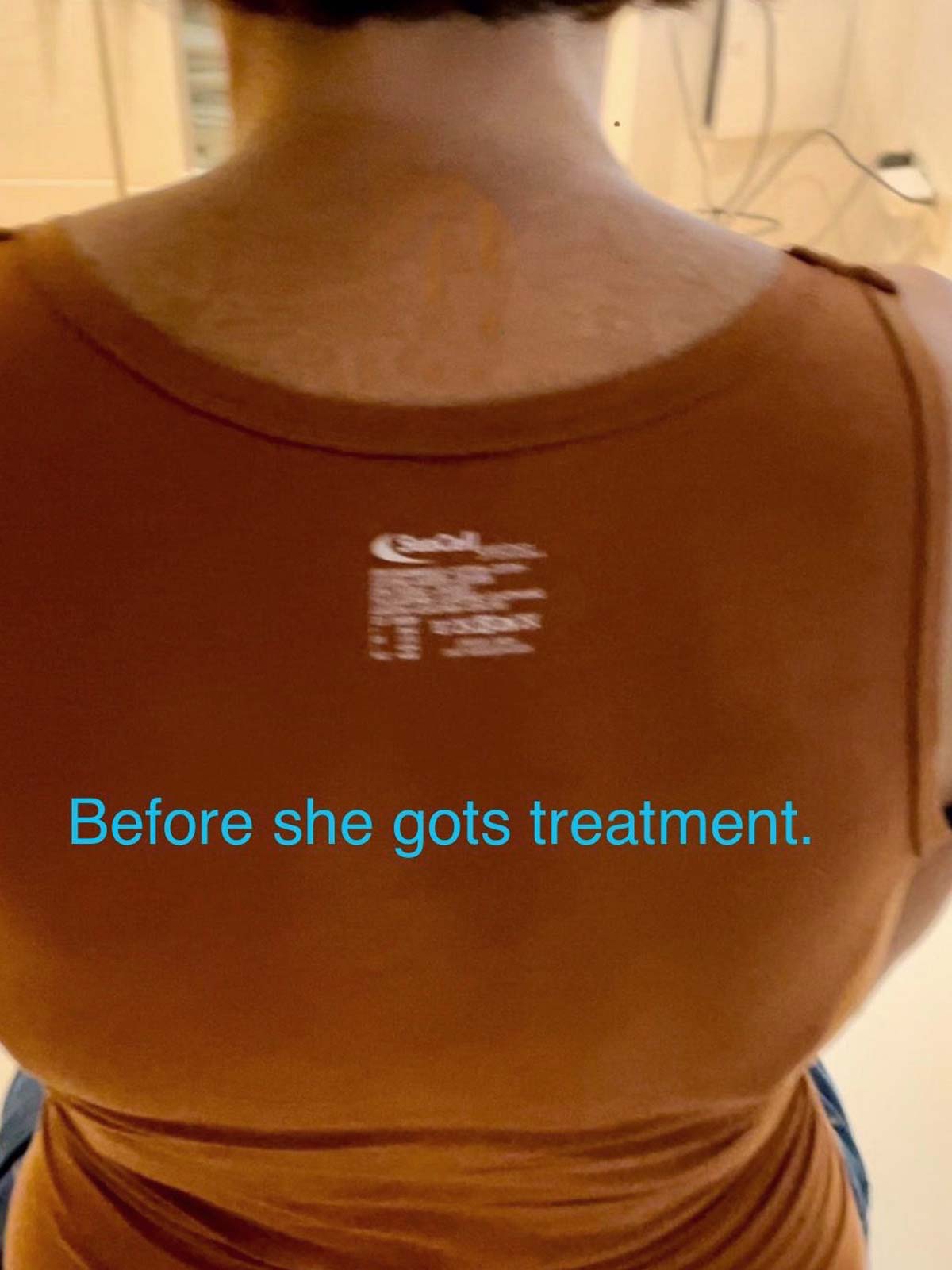 Bauchbehandlung Vorher - Patientin mit Darmproblemen vor der traditionellen Thai Massage